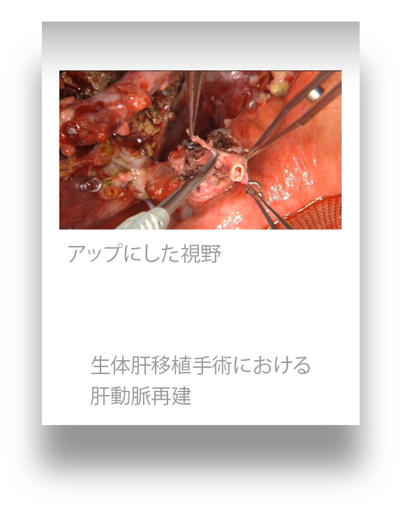 生体肝移植における肝動脈再建