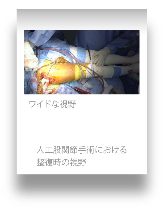 人工股関節手術における整復時の視野